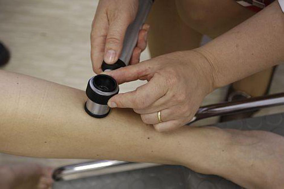 Skupaj so dermatologi zadnji dan v maju pregledali okoli 400 ljudi. | Avtor: Žurnal24 main