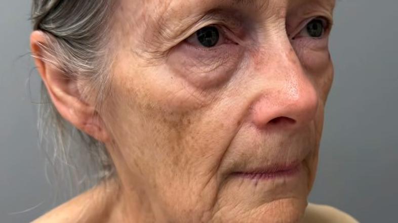 Plastična operacija