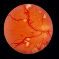diabetična retinopatija