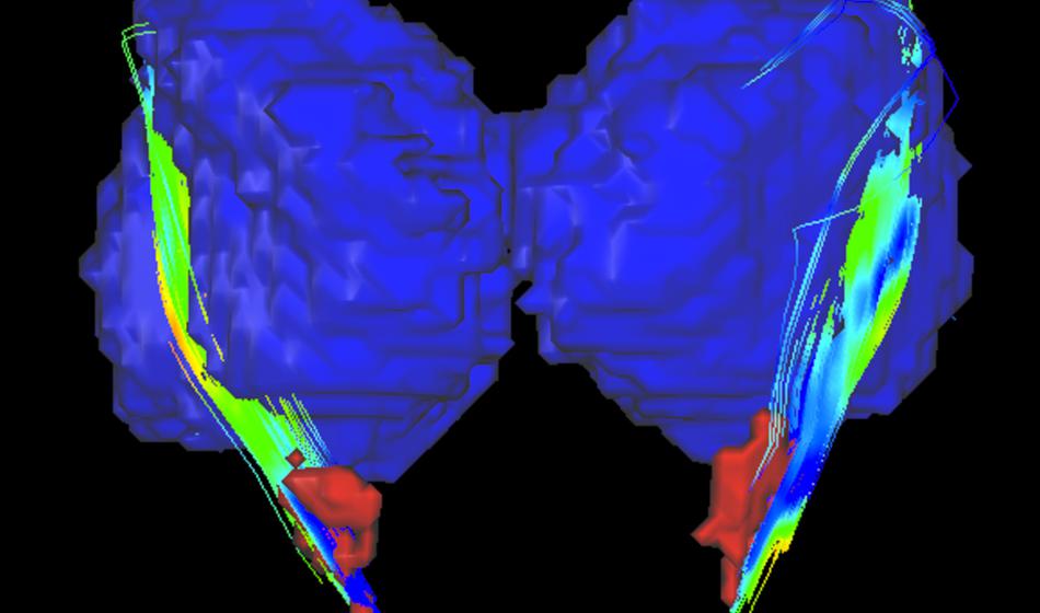 To hudo bolezen ima pri nas 11 tisoč ljudi, mnogi gredo k zdravniku prepozno