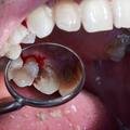 zobje, ustna higiena