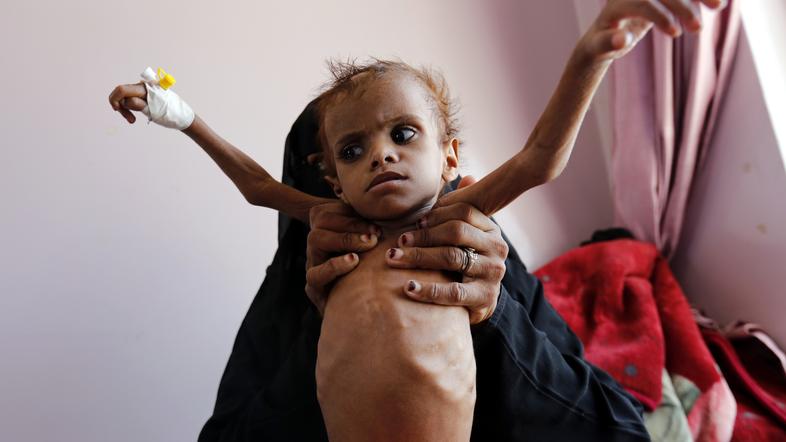 Jemen otroci lakota