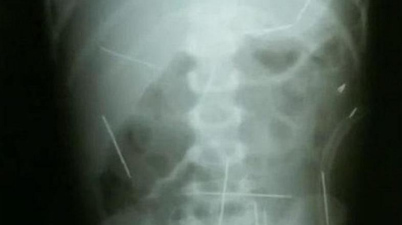 Igle ogrožajo dečkovo srce. (Foto: globo.com)