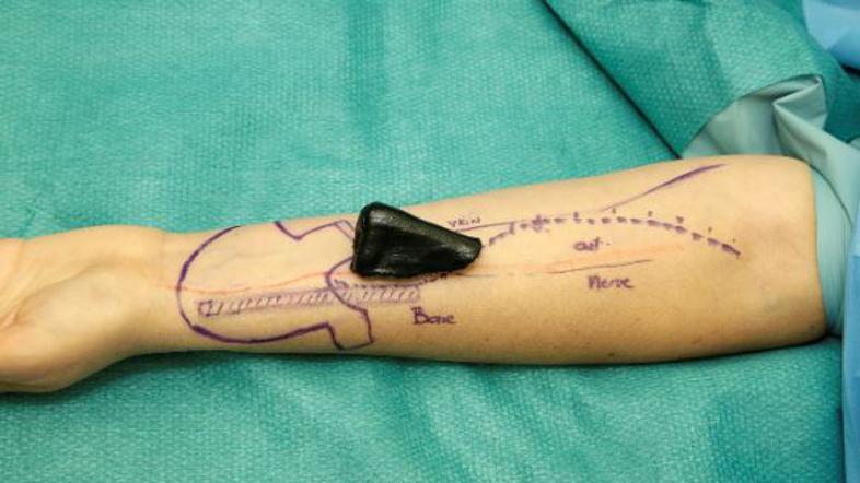 Mikrokirurška rekonstrukcija nosu v UKC Ljubljana