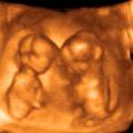 ultrazvok dvojčka