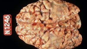 Meningitis možgani