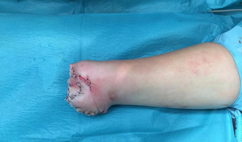 Huda poškodba otroka s pirotehniko