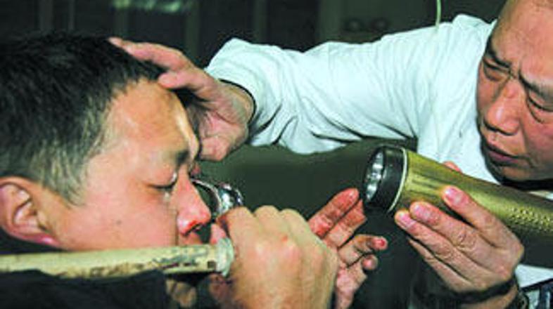 Zdravniki niso vedeli, kako Zhau cev odstraniti iz njegove glave.