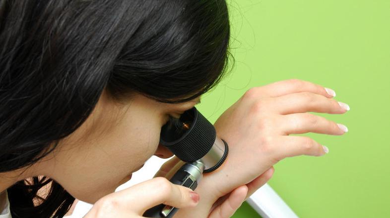 Na pregled pojdite, kadar opazite sumljive spremembe, opisane v ABCDE-sistemu, a