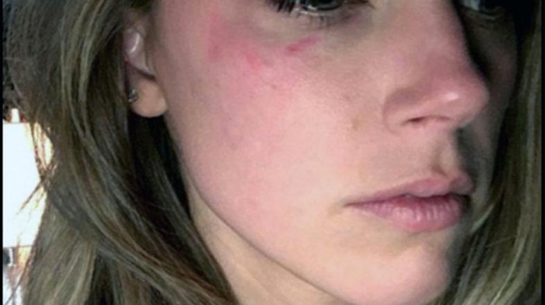 Amber Heard modrice Johnny Depp