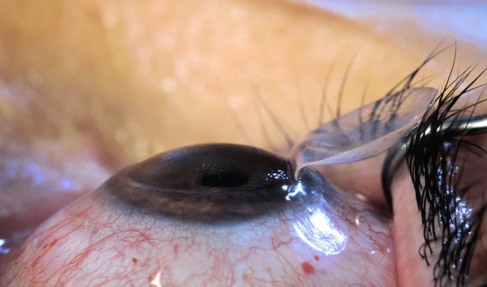 Dva otroka oslepela zaradi nevarne igre z laserjem