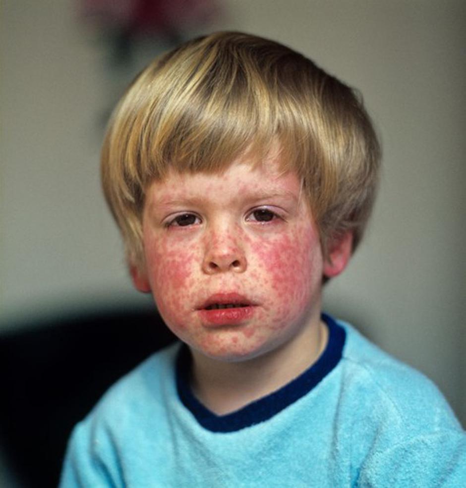 ošpice | Avtor: Profimedias