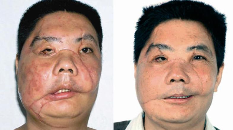 Leta 2006 so na Kitajskem transplantacijo obraza opravili na moškem, ki ga je na