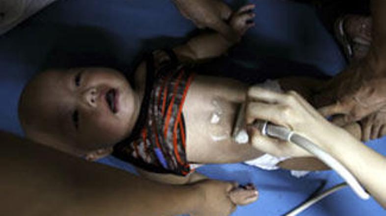 Od izbruha škandala so pregledali že 40.000 otrok.