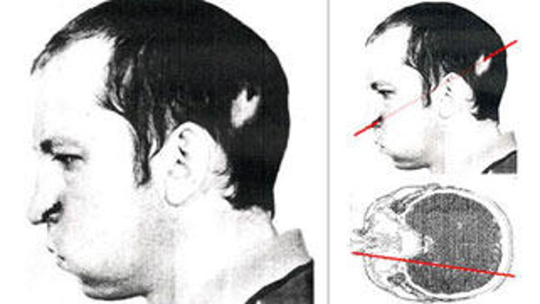 Snop je vstopil v glavo na levi strani zatilja in izstopil blizu leve nosnice.