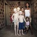 Otroci, ki so v Afriki rojeni kot albini, so pogosto žrtve neumnih vraž. (Foto: 