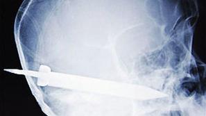 Mladenič je z nožem v glavi prikorakal v bolnišnico.