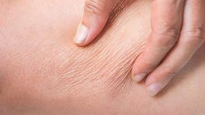 Kolagen DELUJE! Vendar ne storite te usodne napake!