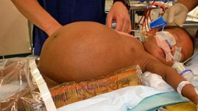 Dečku so iz trebušne votline odstranili tumor, ki je pritiskal na vse notranje o