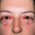 virusni konjuktivitis
