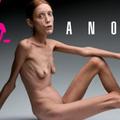 Anoreksija je bolezen.