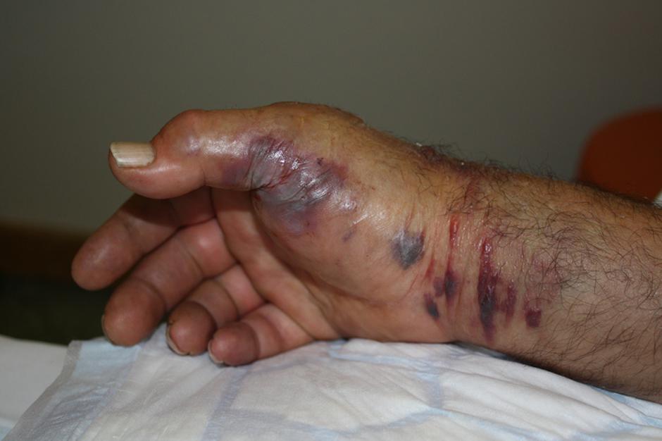 ugriz kače | Avtor: UKCLJ