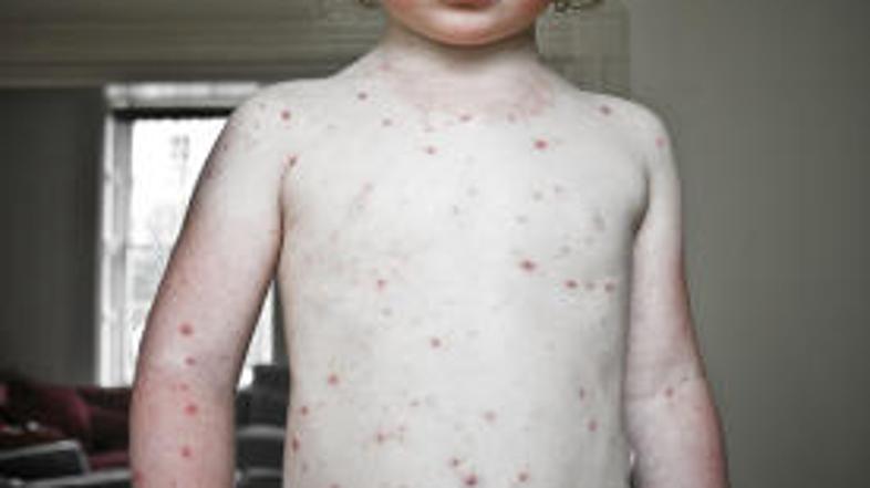 Otrok naj še en teden po prebolelem virusu ostane doma.