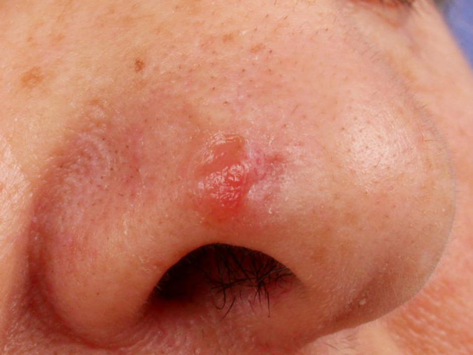 Kožni rak | Avtor: Profimedias