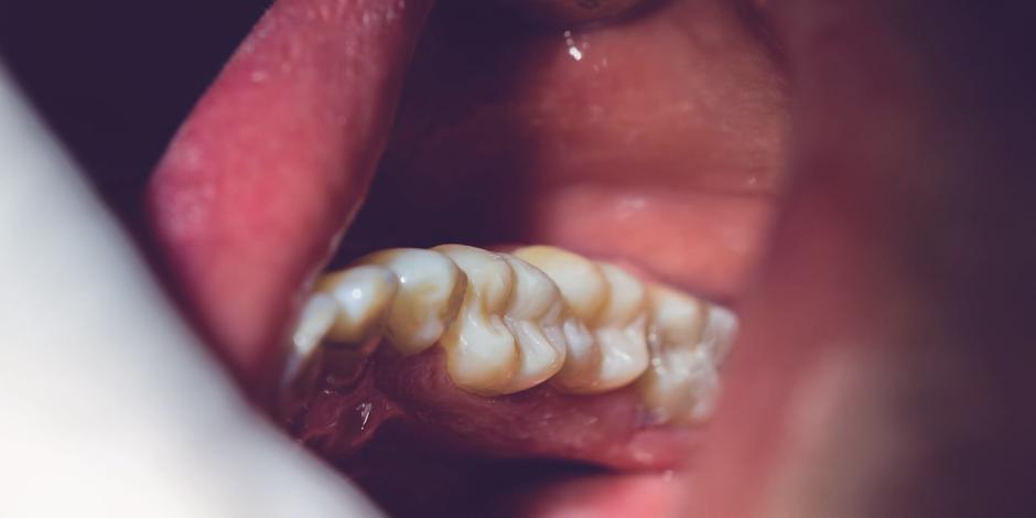 Sowelo, plobma, zobje, amalgam | Avtor: Sowelo