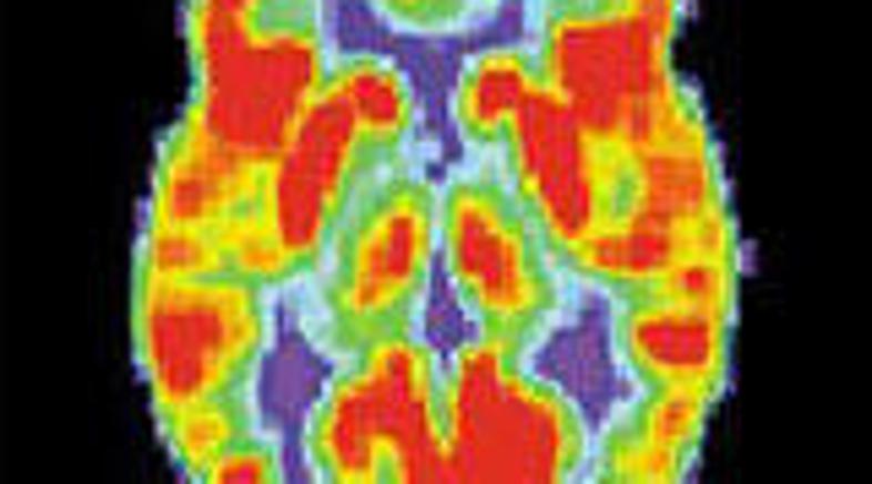 PET slika zdravih možganov ...