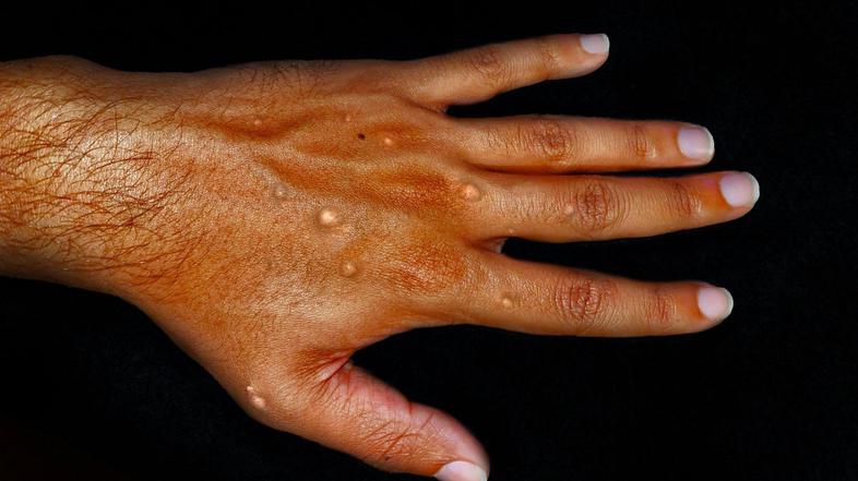 opičje koze izpuščaj