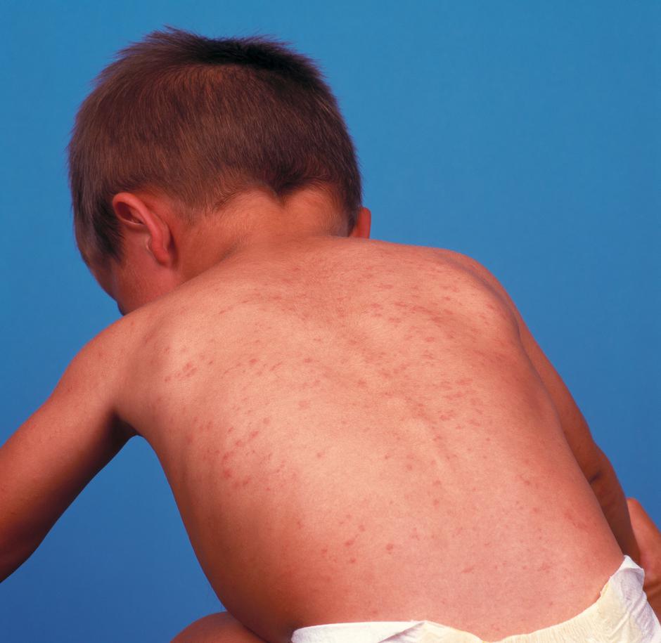 Ošpice | Avtor: Profimedia