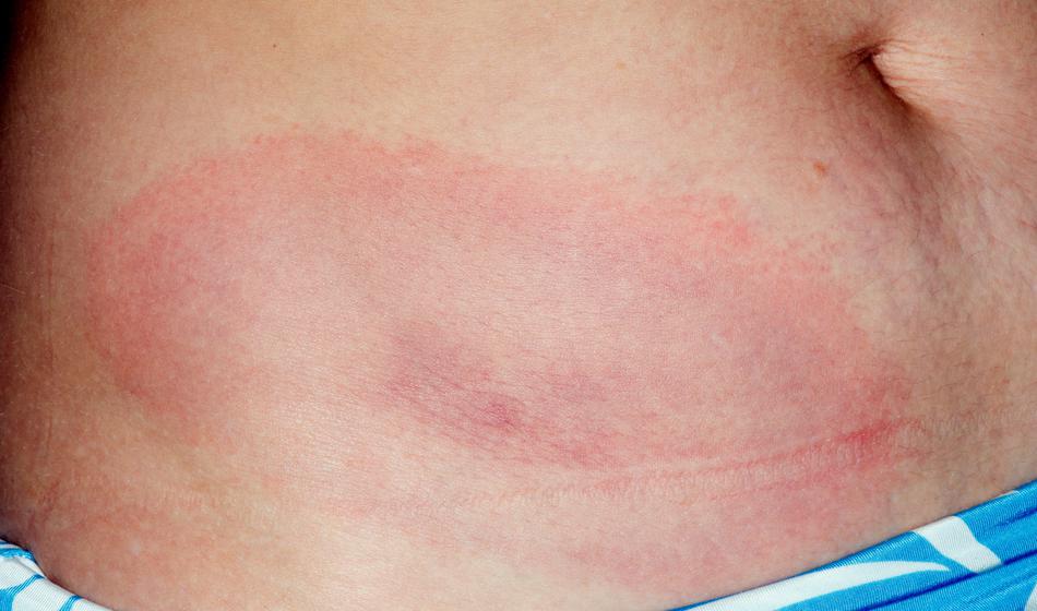 Vse več primerov lymske borelioze: nujnost preventivne zaščite pred klopi