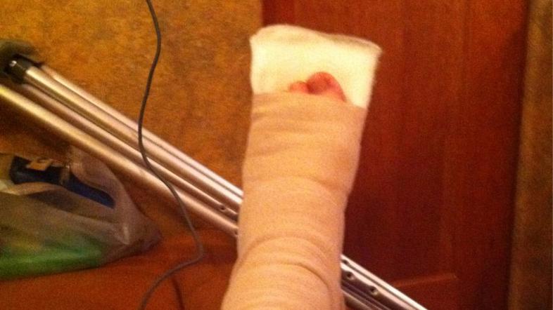 Brendonova noga po zdravniški pomoči. (Foto: Twitter)