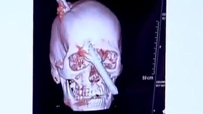 Preživel s palico v glavi 