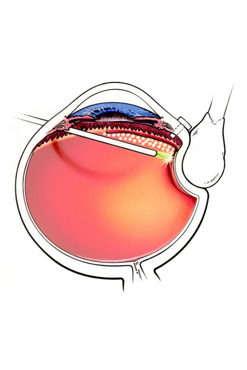  laserska fotokoagulacija | Avtor: Profimedias