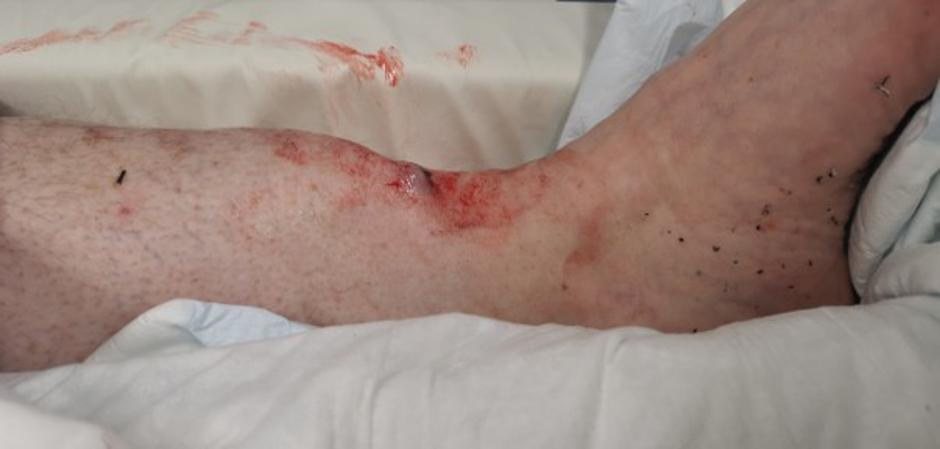 Poškodbe zaradi e-skirojev | Avtor: UKC/Uroš Tominc