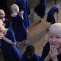 Albino otroci so pogosto tarče napadalcev, ki jih hladnokrvo ubijejo in razkosaj