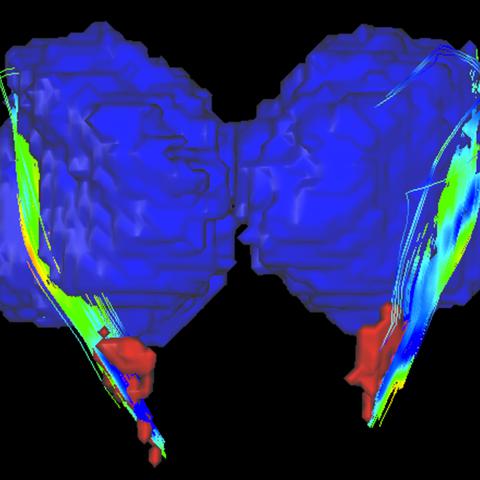Parkinsonova bolezen