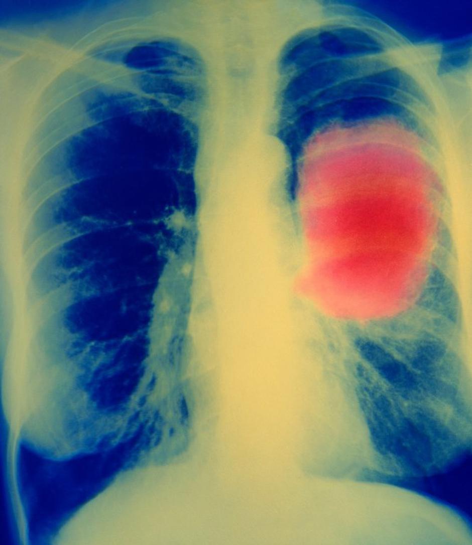 Rak na pljučih | Avtor: Profimedias