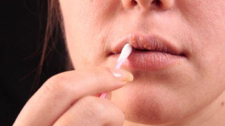 Zaradi spremljajočega srbenja, skelenja in oviranega premikanja ustnic se ga ne 