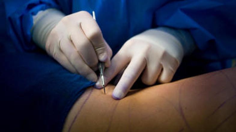 Liposukcija je vedno bolj priljubljena tudi med moškimi.