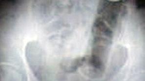 Rentgenska slika je pokazala, da ima pacientka v anusu veliko pločevinko.