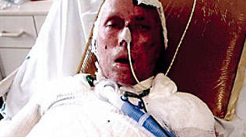 Richard Plotkin bo ostal iznakažen do konca življenja.