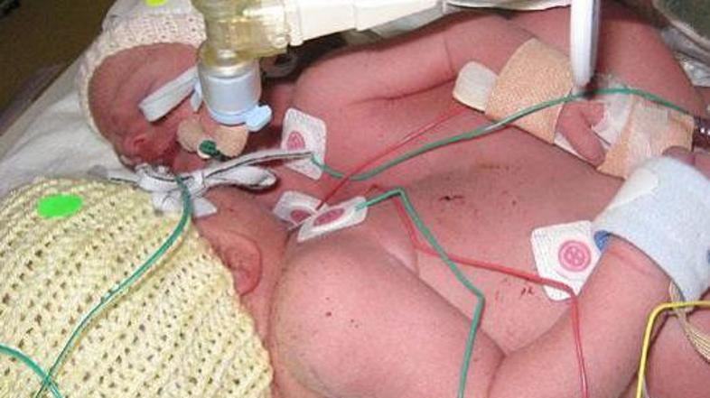 Operacija je potekala v londonski bolnišnici Great Odmond.