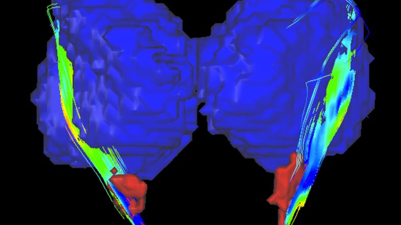 Parkinsonova bolezen