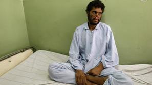 Kabulski zdravniki upajo, da bodo z operacijo, pri kateri bodo s čela na nos pre