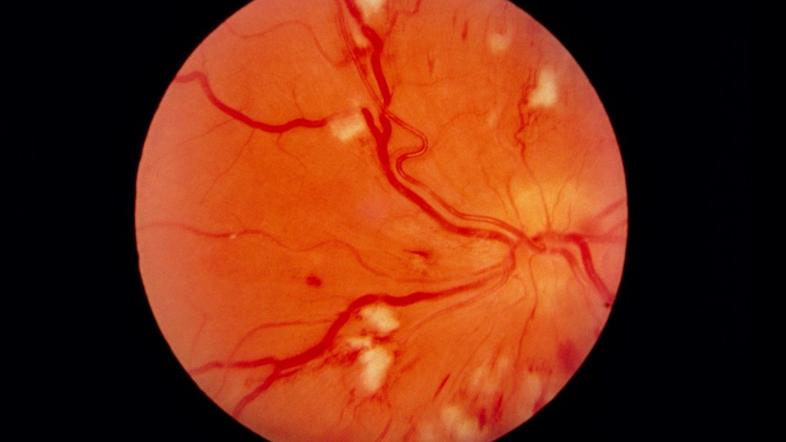 diabetična retinopatija