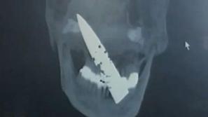 Zdravniki so v glavi Kitajca, ki se je pritoževal nad kroničnimi glavoboli, odkr