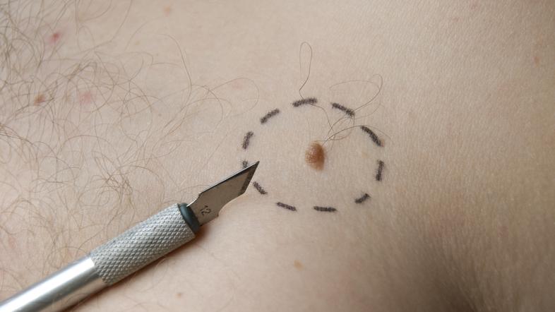 Melanom je najbolj nevarna oblika kožnega raka, ki se brez zdravljenja lahko kon